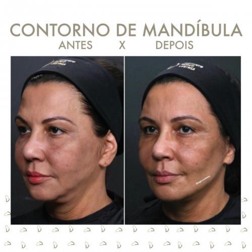 ANTES E DEPOIS CONTORNO DA MANDÍBULA