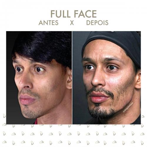 ANTES E DEPOIS FULL FACE CARLOS