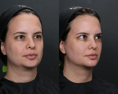 Antes e depois