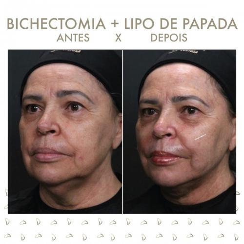 Antes e depois