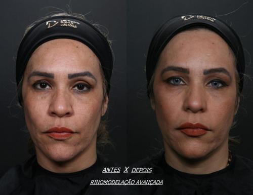 ANTES E DEPOIS RINO AVANÇADA 