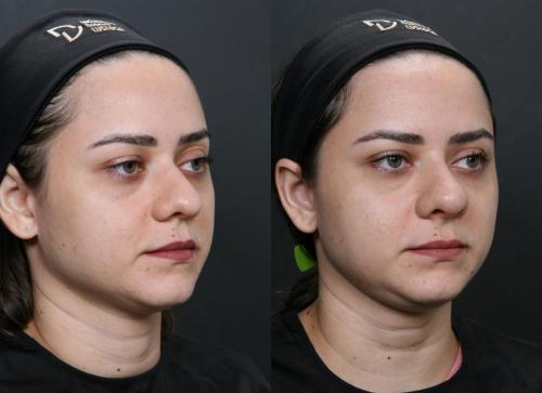 ANTES E DEPOIS RINOMODELAÇÃO 01