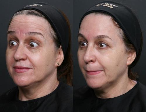 Antes e depois